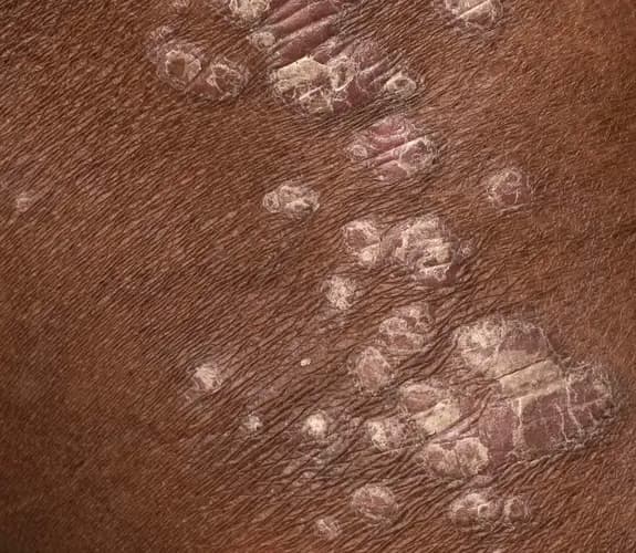 Psoriasis